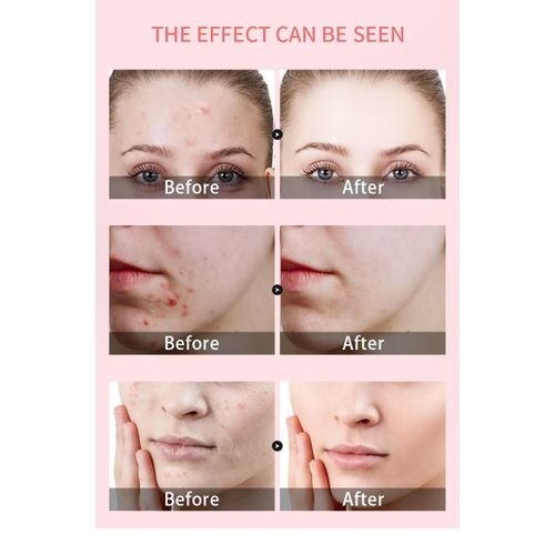 Hydrocolloid pimple patches